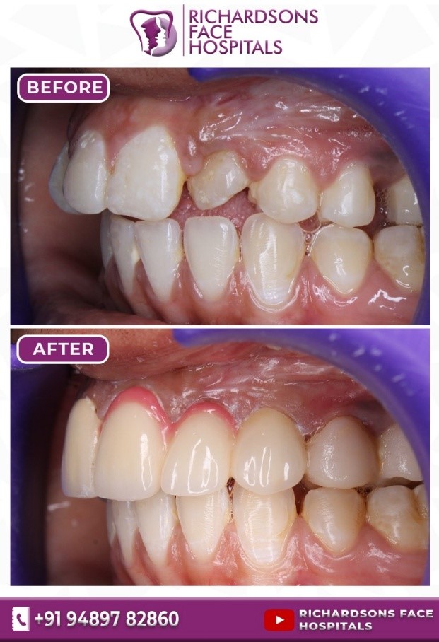 Digital Smile Designing (Teeth): Before & After