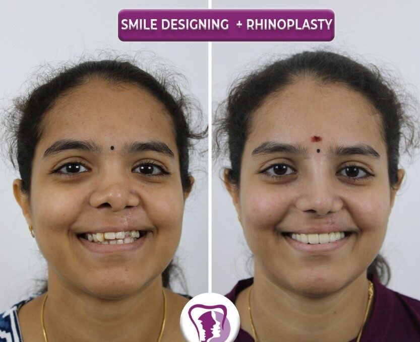 Dental Smile Designing