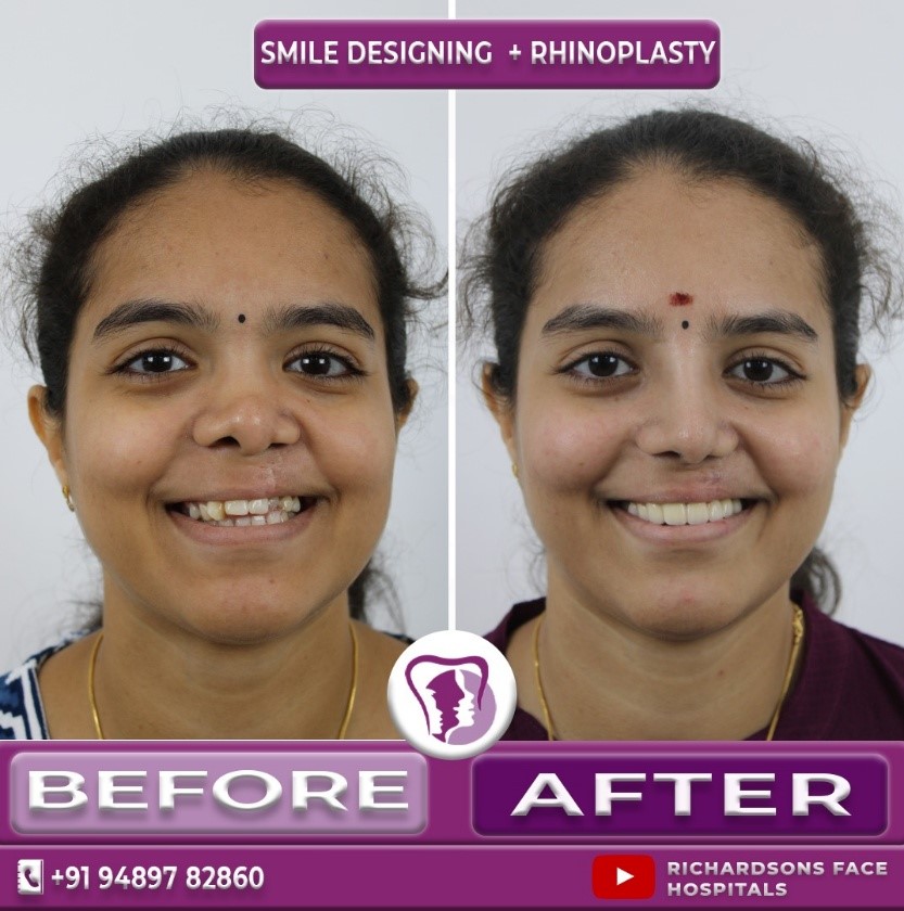Female Digital Smile Designing Front Profile: Before & After