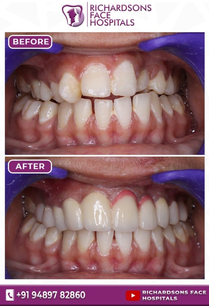 Digital Smile Designing (Teeth): Before & After