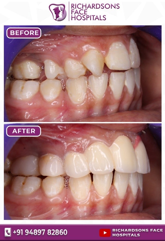 Digital Smile Designing (Teeth): Before & After