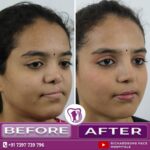 Cleft Redo Rhinoplasty