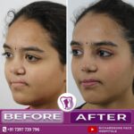 Cleft Redo Rhinoplasty