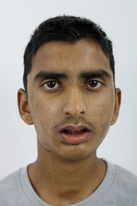 Male Front Profile Pre-Op: Bilateral Temporomandibular Joint Ankylosis