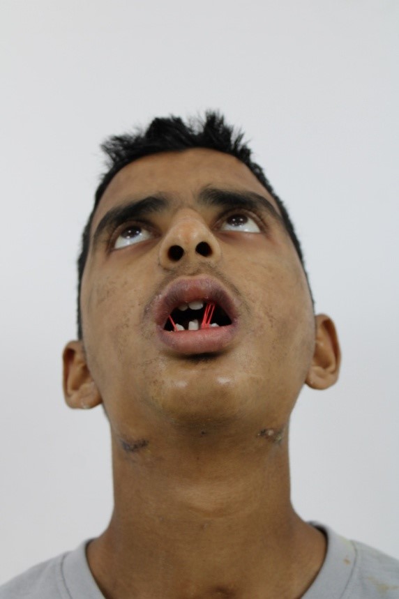 Male Bottom Profile Pre-Op: Bilateral Temporomandibular Joint Ankylosis