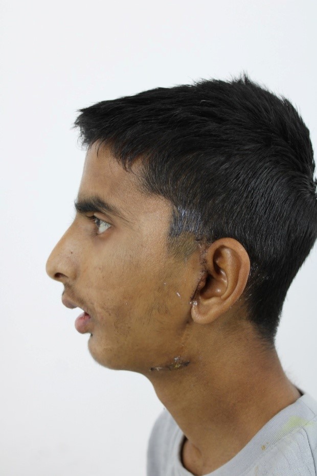 Male Side Profile Pre-Op: Bilateral Temporomandibular Joint Ankylosis