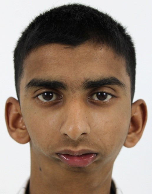 Male Front Profile Pre-Op: Bilateral Temporomandibular Joint Ankylosis