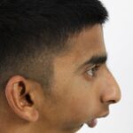 1 TMJ ANkylosis PreOP 2