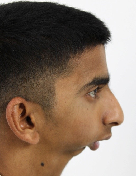 Male Side Profile Pre-Op: Bilateral Temporomandibular Joint Ankylosis