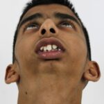 1 TMJ ANkylosis PreOP 3