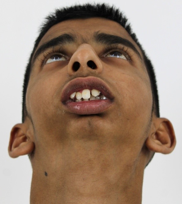 Male Bottom Profile Pre-Op: Bilateral Temporomandibular Joint Ankylosis