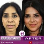 Rhinoplasty & Chin Contouring Surgery