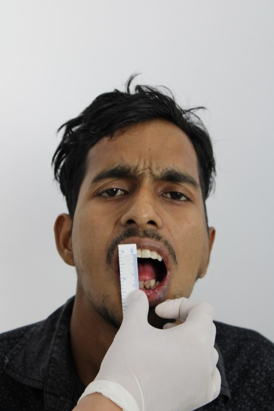 Male Front Profile Post-Op: Left Sided Temporomandibular Joint Ankylosis