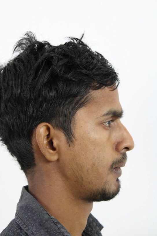 Male Side Profile Post-Op: Left Sided Temporomandibular Joint Ankylosis