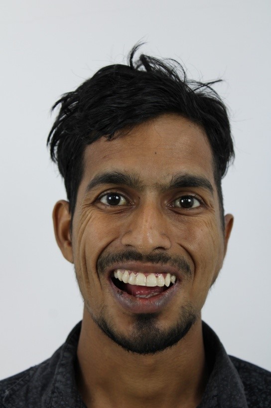 Male Front Profile Post-Op: Left Sided Temporomandibular Joint Ankylosis