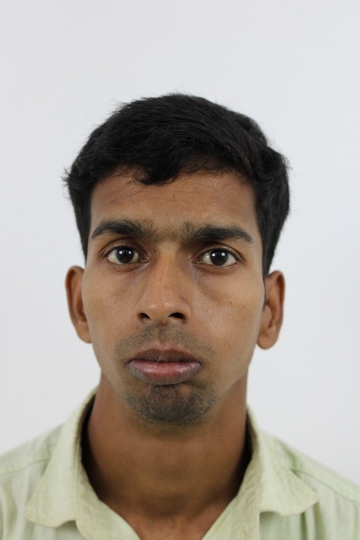 Male Front Profile Pre-Op: Left Sided Temporomandibular Joint Ankylosis