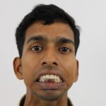 2 TMJ ANkylosis PreOP 2