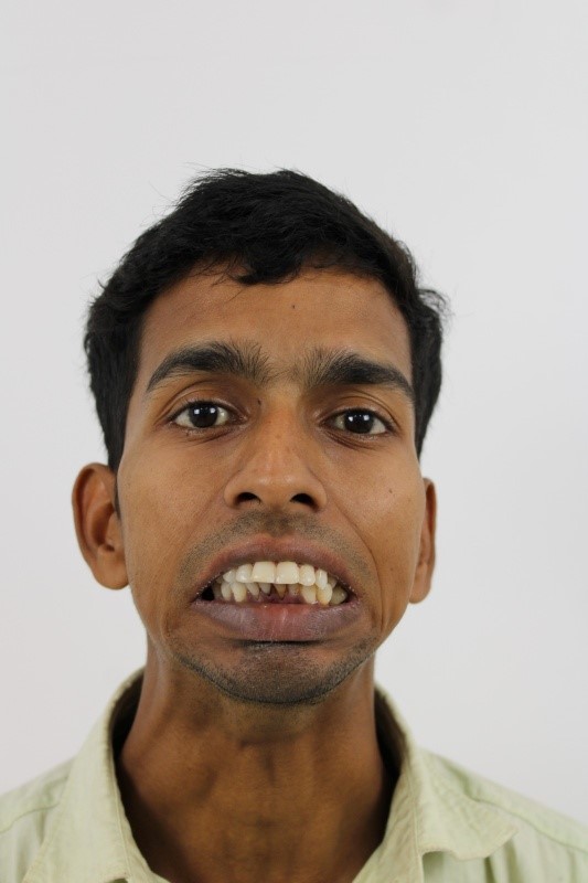 Male Front Profile Pre-Op: Left Sided Temporomandibular Joint Ankylosis 2