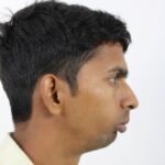 2 TMJ ANkylosis PreOP 3