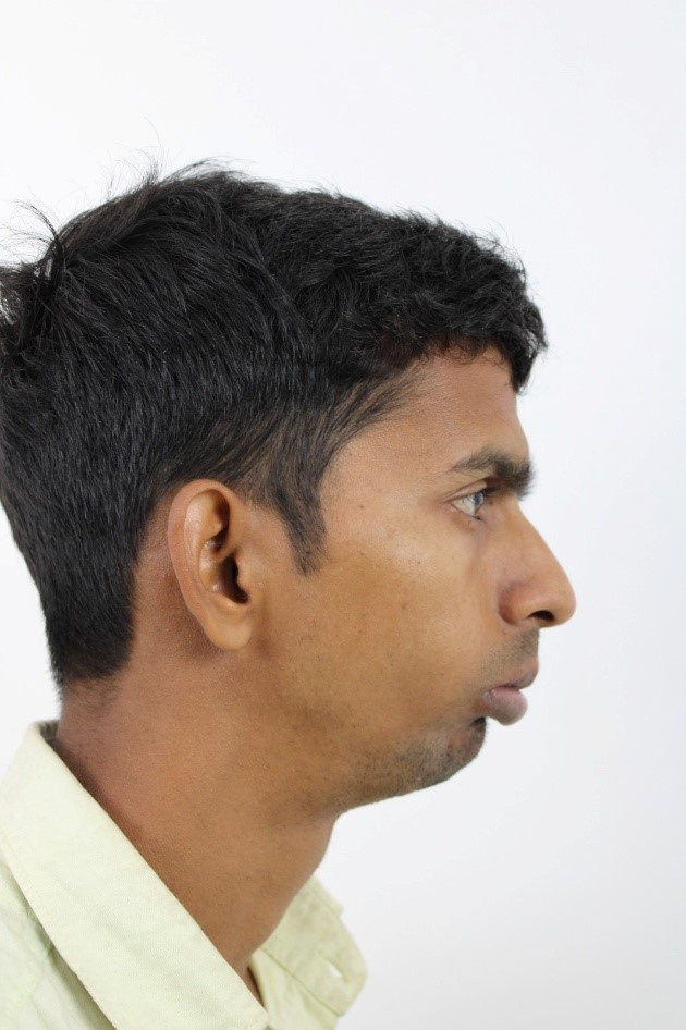 Male Side Profile Pre-Op: Left Sided Temporomandibular Joint Ankylosis