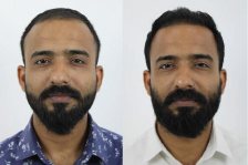 Hair Transplant: Before & After