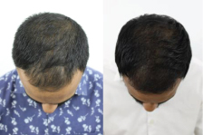Hair Transplant: Before & After