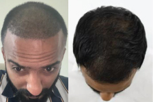 Hair Transplant: After