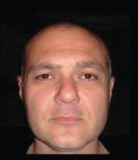 Euryporsopic (Broad Face Type)