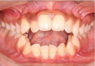 Case of anterior open bite