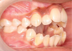 Case of anterior open bite