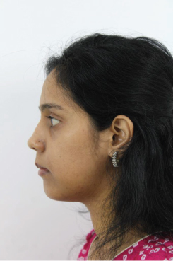 Maxillary Impaction 1