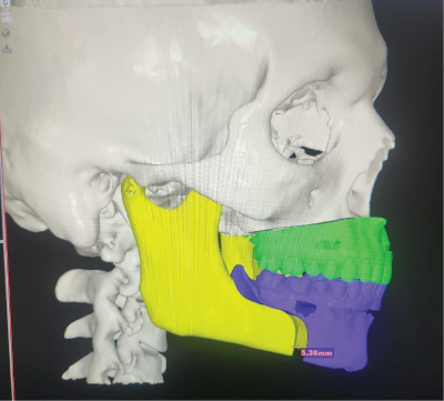 Jaw Surgery highlighted illustration