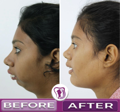 Jaw Surgery Before and After 1