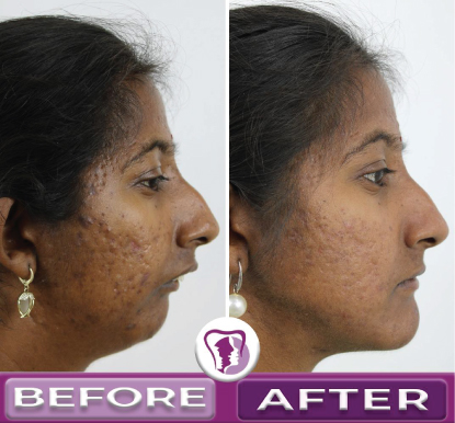 Jaw Surgery Before and After 2