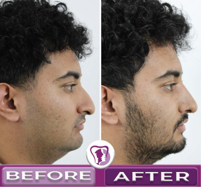 Jaw Surgery Before and After 3