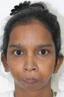 Euryprosopic Facial Type