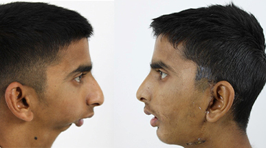 Temporomandibular Joint Ankylosis