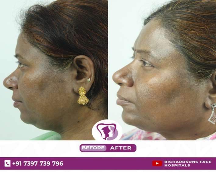 Melasma - Beforeo & After