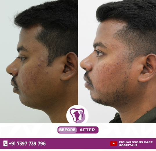 Post-Inflammatory Hyperpigmentation - Before and After