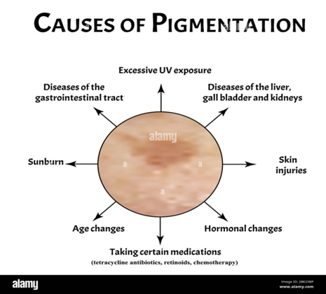 Causes of skin Hyperpigmentation