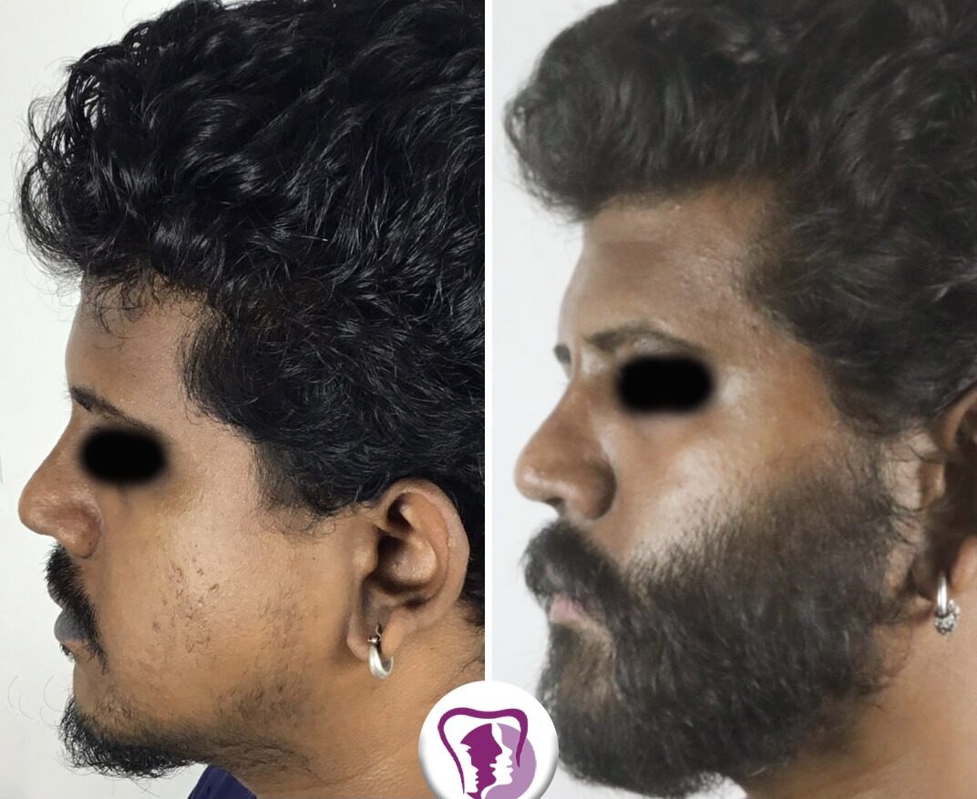 Beard transplant, Hair Transplant