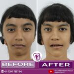 TMJ joint Reconstruction with Orthognathic Surgery 
