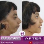 TMJ joint Reconstruction with Orthognathic Surgery 