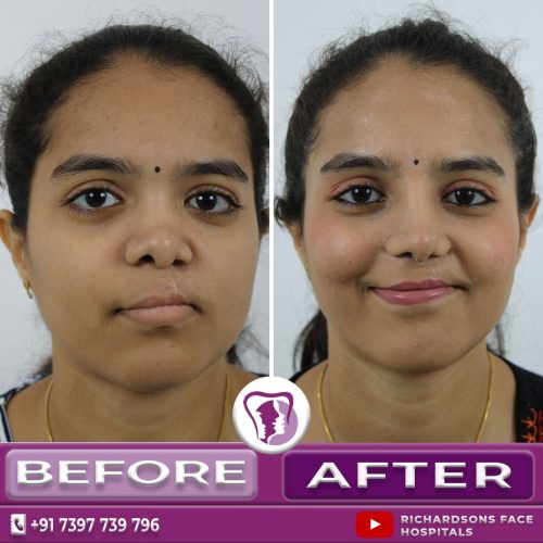 Cleft Redo Rhinoplasty