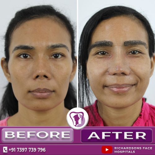Redo Cosmetic Rhinoplasty