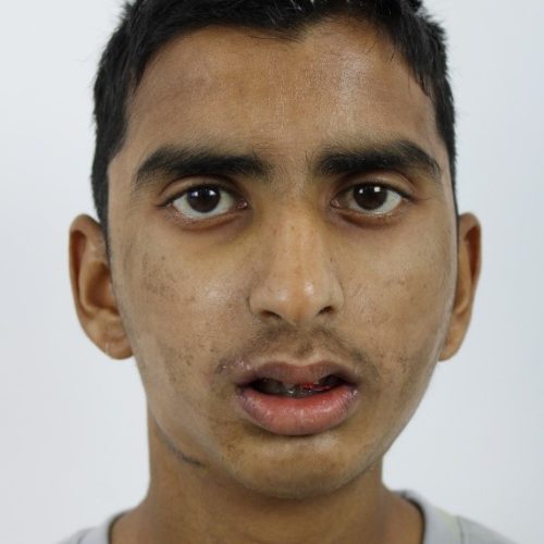 1 TMJ ANkylosis PostOP 1