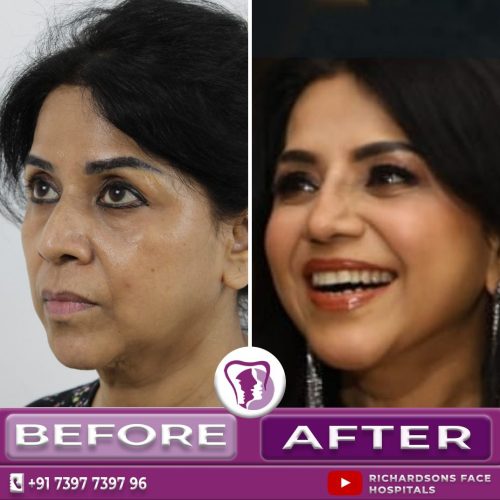 Rhinoplasty & Chin Contouring Surgery