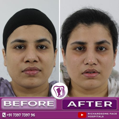 Cosmetic Rhinoplasty