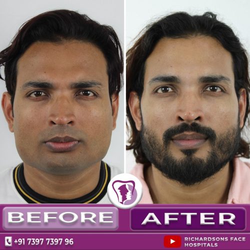 Facemakeover With jaw surgery and nose surgery