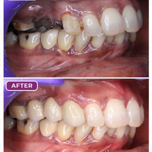 Single-Day Prosthesis